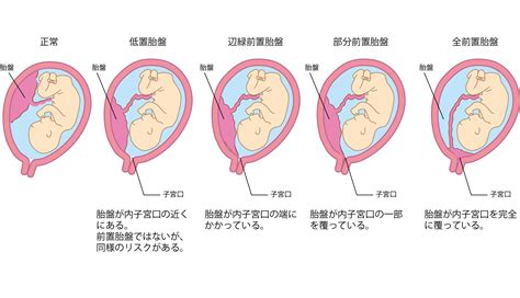 前置胎盤原因|前置胎盤とは？原因や治し方、日常生活の過ごし方、。